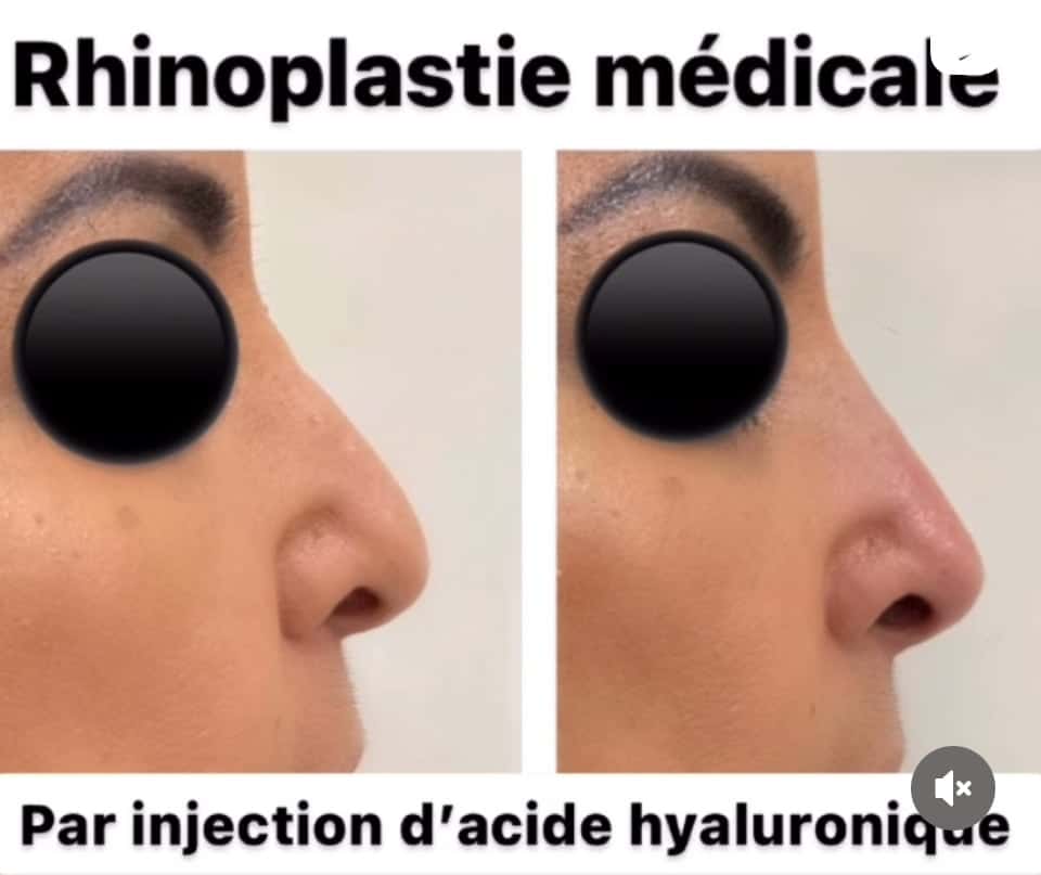 Rhinoplastie médicale femme Bordeaux