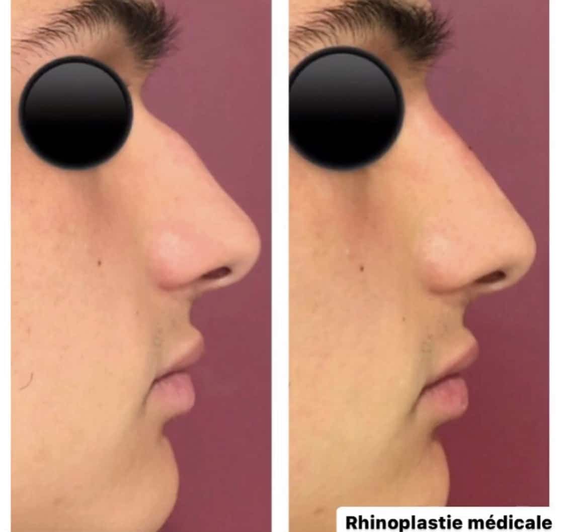 Rhinoplastie médicale homme Bordeaux