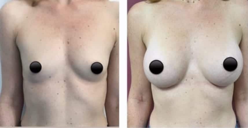image avant après augmentation mammaire