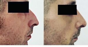 Photos avant après rhinoplastie de l'homme