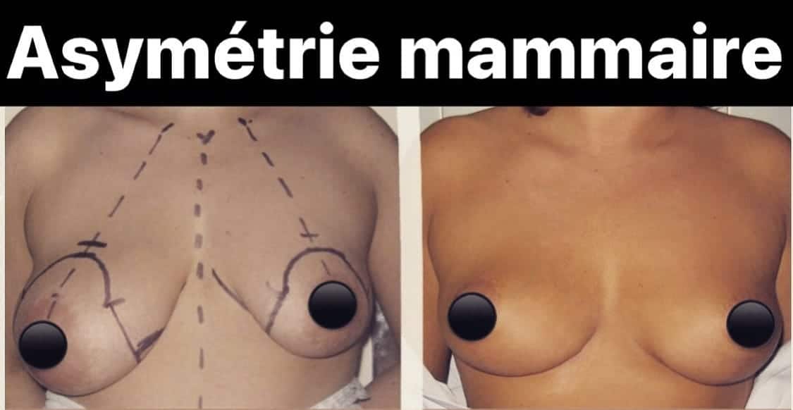Photos avant après ptose mammaire