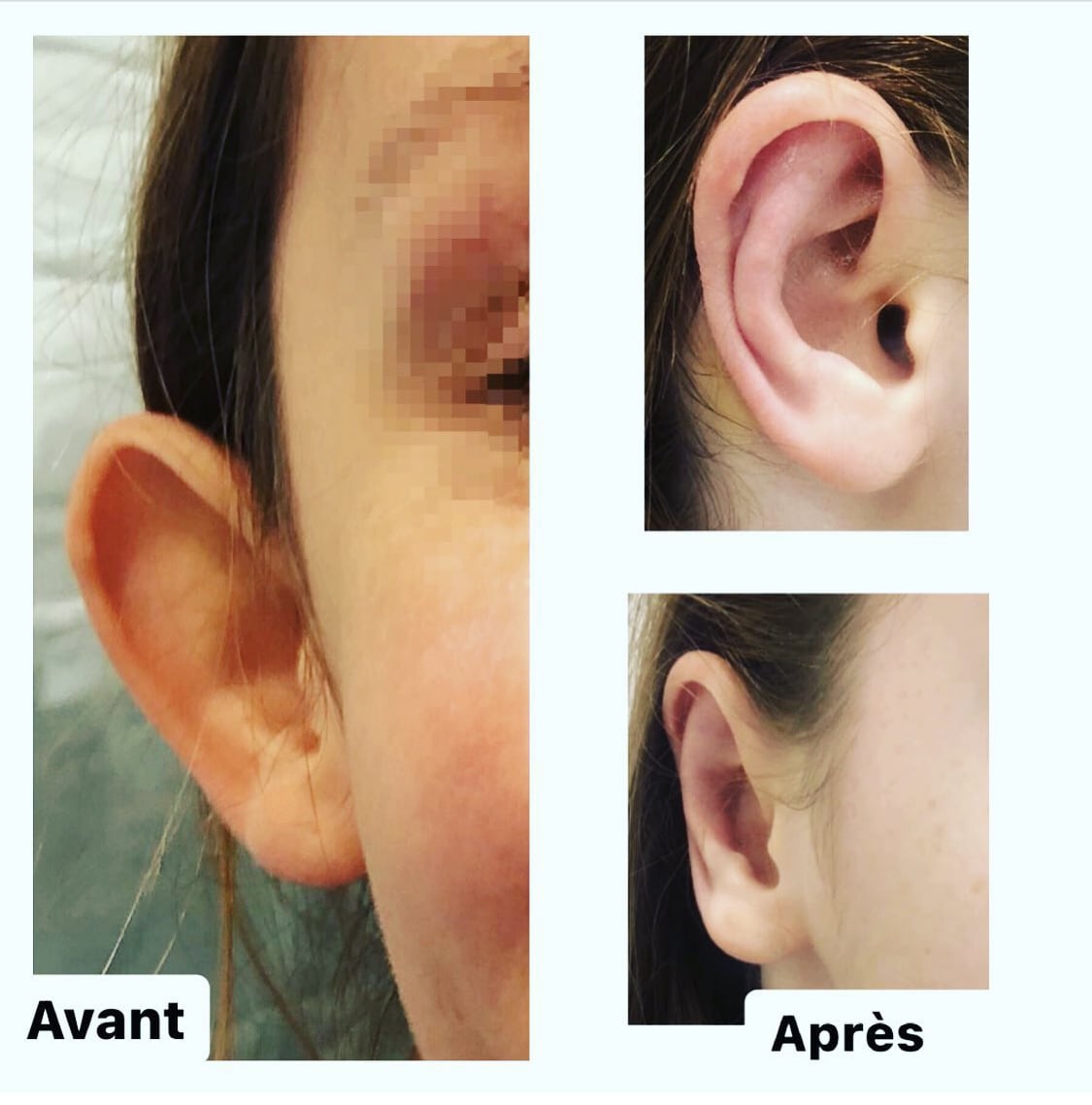 chirurgie des oreilles femmes