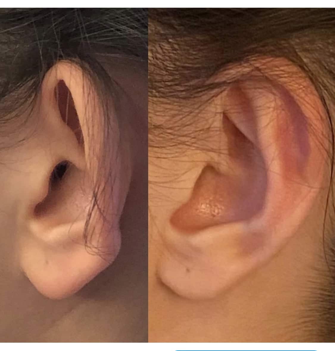 chirurgie des oreilles femmes